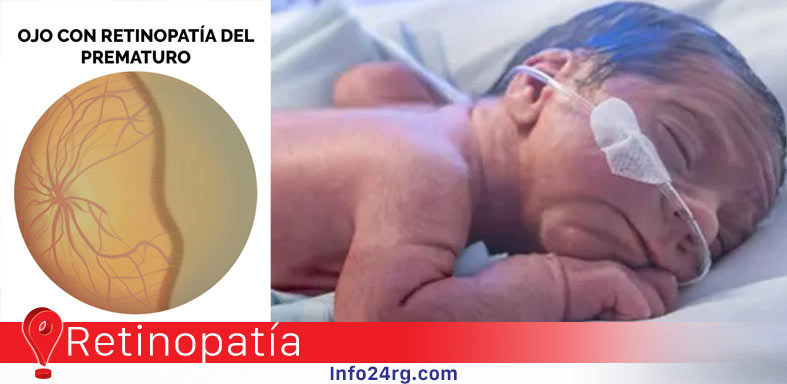 Retinopatía del prematuro